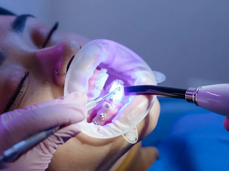 Blanqueamiento dental: qué debes saber antes de hacerlo